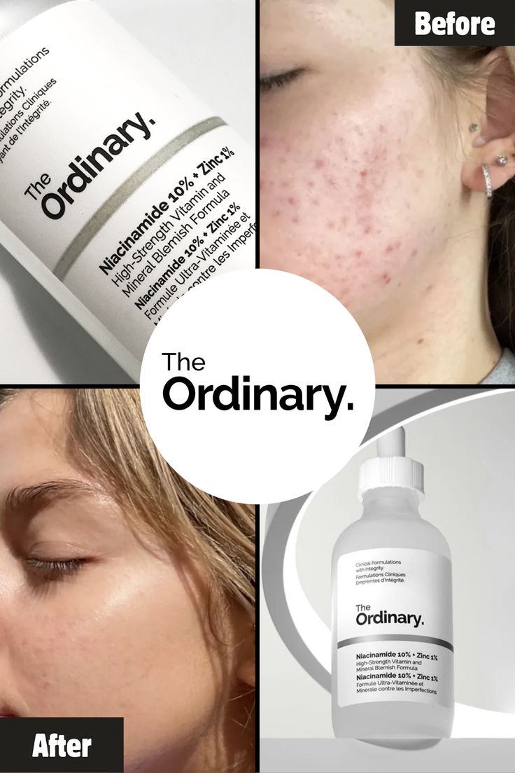 Advanced Niacinamide Serum for Even & Glowing Skin